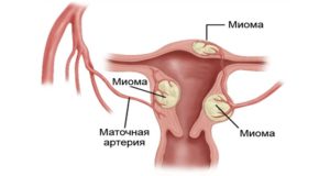 Лечение маленькой миомы