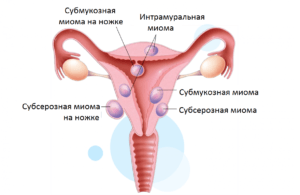 Субмукозная (подслизистая) миома