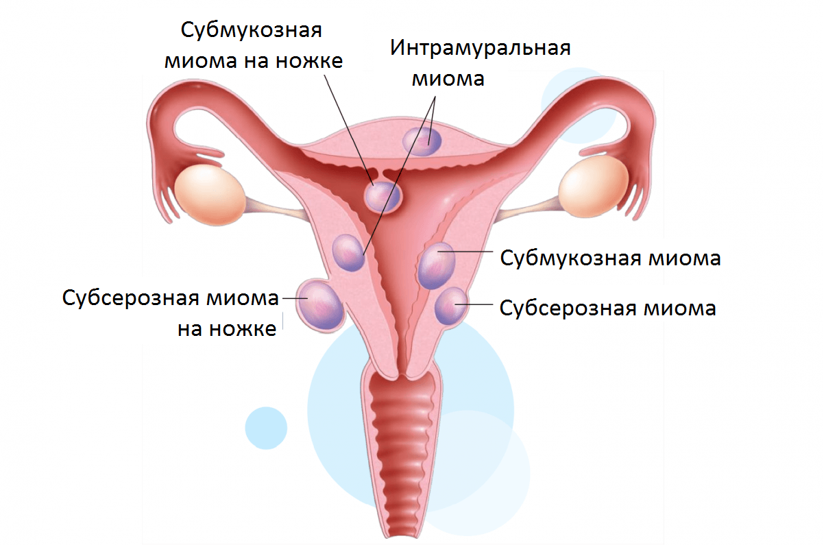 Субмукозная (подслизистая) миома